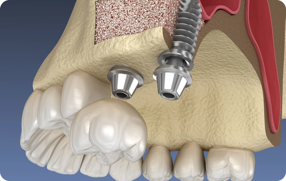 sinus-lift-tourcoing-modernes